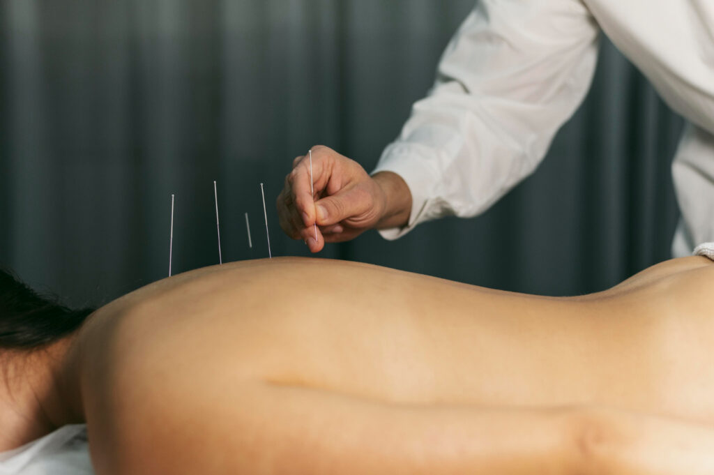 Myofascial Dry Needling Therapy